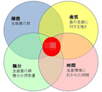 虫歯の4大因子